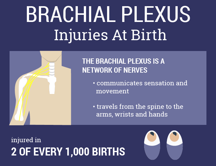 Brachial Plexus Injuries Infographic