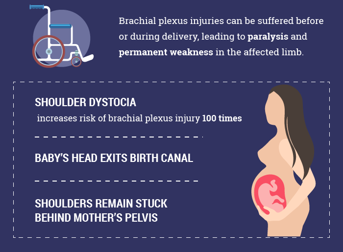 Brachial Plexus Injury Causes Infographic
