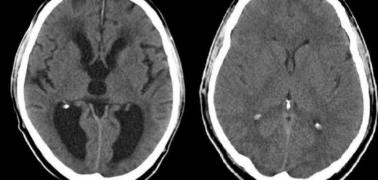 Hydrocephalus MRI