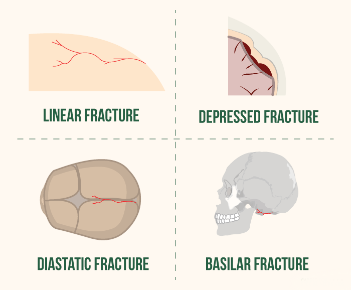 Skull Fracture Type Infographic