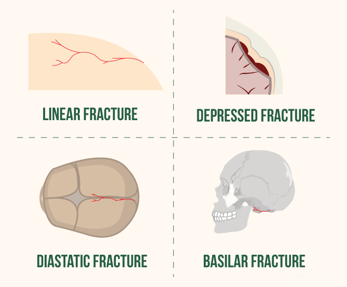 simple skull fracture